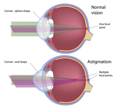 Testing for Astigmatism: What You Need to Know .